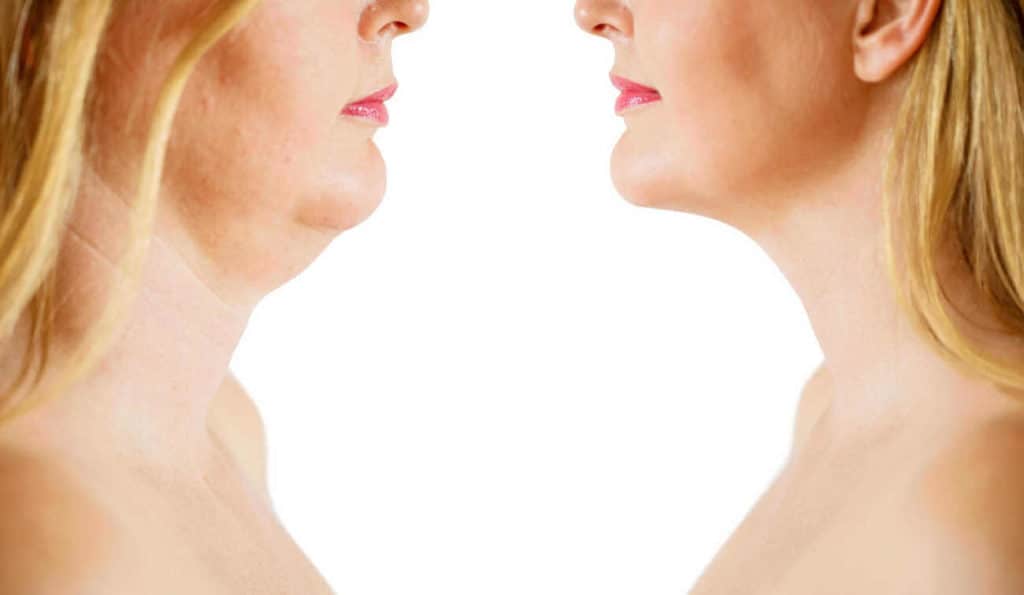Double Chin treatment Lincolnshire before and after results
