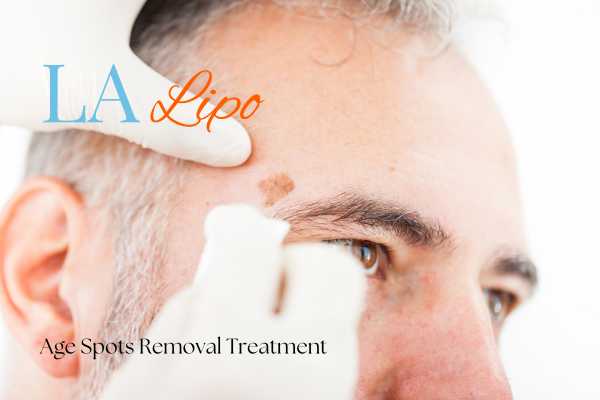 What Are the Most Effective Treatments for Age Spots Lincolnshire?