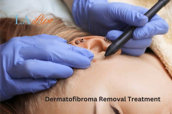 Dermatofibroma Removal Treatment Lincolnshire