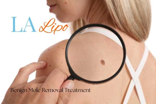 Woman having her inspection of blemish before mole removal Lincolnshire