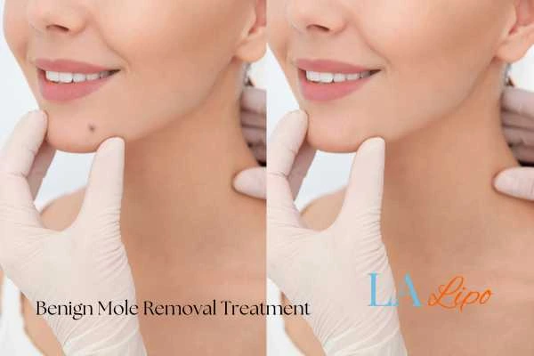 Before and after mole removal Lincolnshire treatment