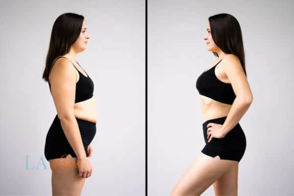 image of woman before and after results of LA-EMS Body Sculpting Lincolnshire to help treat Diastasis recti