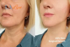 hi-fu for wrinkles Lincolnshire before and after results
