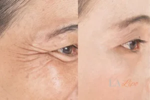 Before and after results of woman - HI-fu wrinkles reduction treatment Lincolnshire