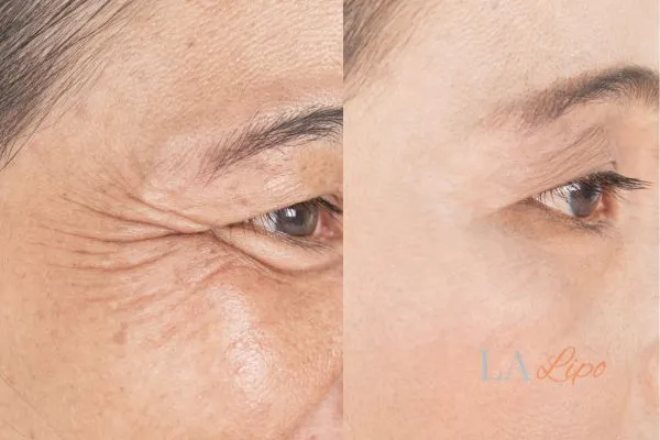 Before and after results of woman - HI-fu wrinkles reduction treatment Lincolnshire