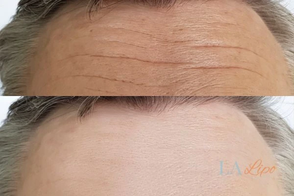 results of HIFU Lincolnshire on mans forehead to help reduce lines and wrinkles