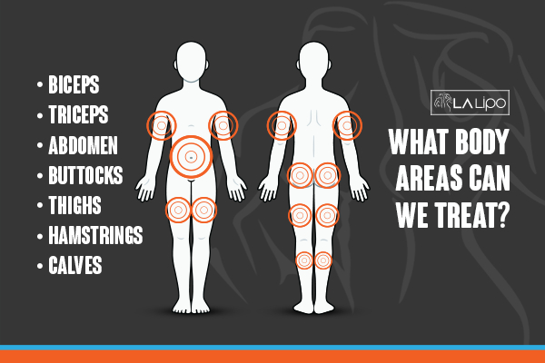 Graphic to show areas you can have LA-EMS Body Sculpting Lincolnshire treatment.