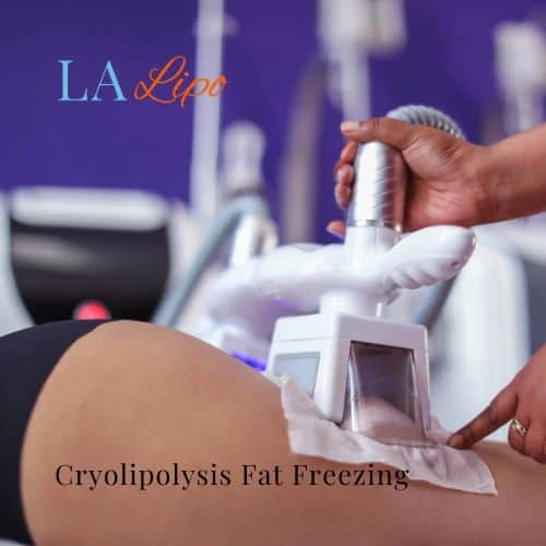 fat freezing - Cryolipolysis Lincolnshire
