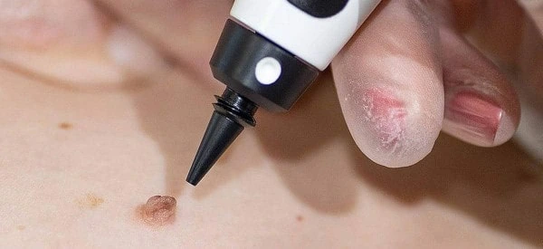skin tag removal using cryopen Lincolnshire