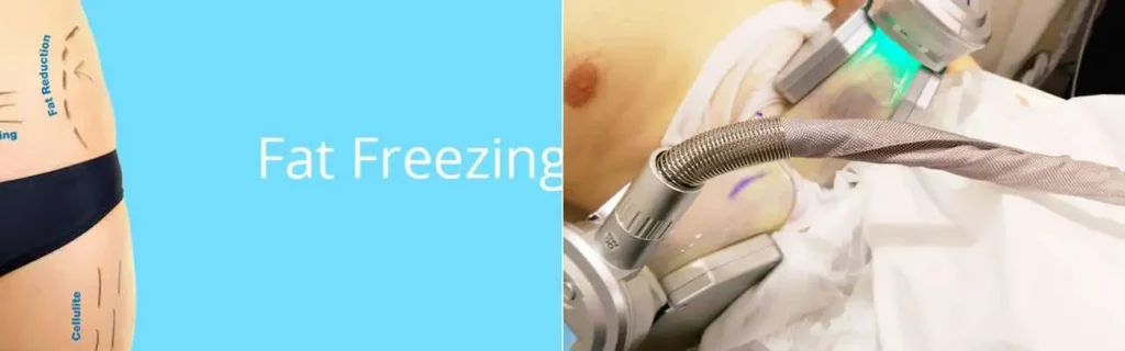 Fat freezing Lincolnshire on multiple areas of the body