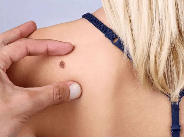 woman having mole removal Lincolnshire consultation before treatment.