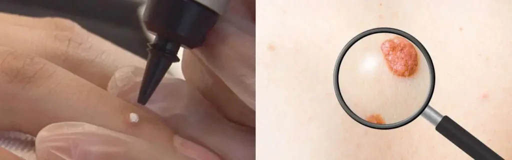 Cryopen for mole removal Lincolnshire - speak to our team today!