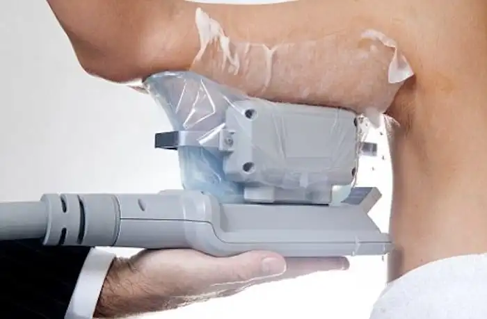 Picture of fat freezing Lincolnshire on the upper arms.