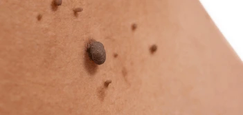 image of a skin tag Lincolnshire