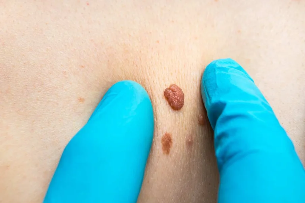 Consultant examining a skin tag Lincolnshire