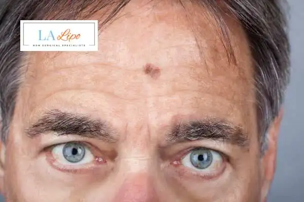 Solar Lentigo Removal Lincolnshire image of man with mark on his forehead