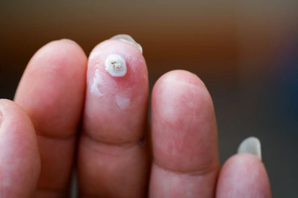 wart on person finger - cryotherapy to treat from LA LIPO Lincolnshire
