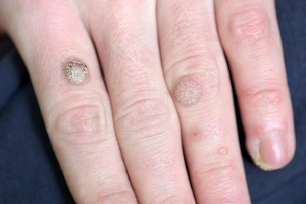photo of warts on person hand - see wart removal Lincolnshire from LA LIPO