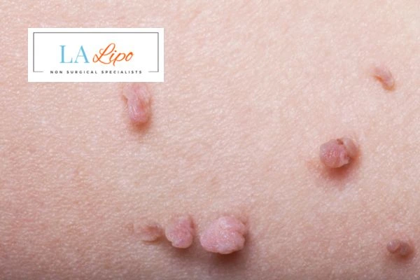 Does cryopen skin tag removal Lincolnshire hurt? Find out now call our team today!