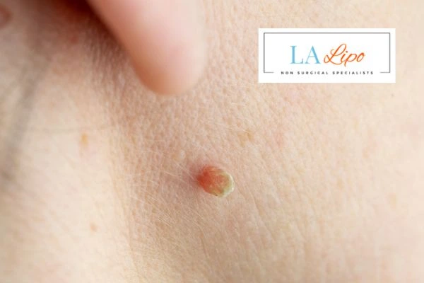 Book skin tag removal Lincolnshire today speak to our team now!