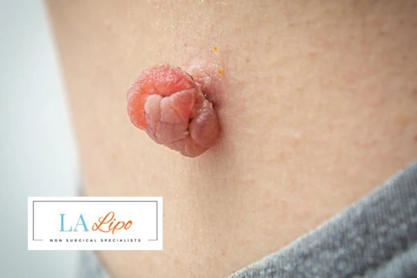 Interested in skin tag removal Lincolnshire? Concerned about the pain? Find out more today!