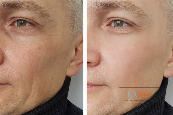 See the amazing results of Morpheus8 Treatment Lincolnshire!