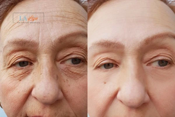 The powerful benefits of Morpheus8 Treatment Lincolnshire - Call Our team today!