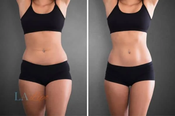 before and after results of non-surgical treatment to help a woman's body image and mental health Lincolnshire