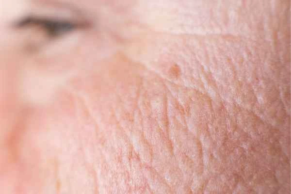 close up picture of a woman's face showing an age spot Lincolnshire