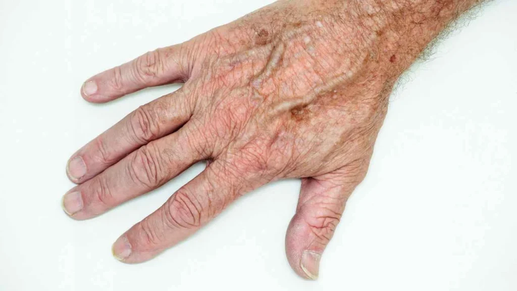 Male hand showing age spot Lincolnshire
