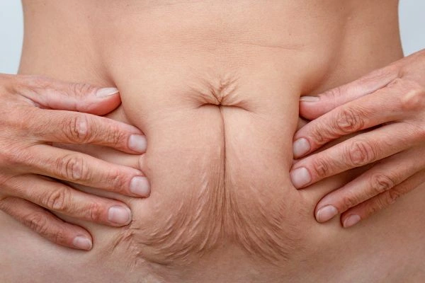 Image of a woman's stomach with loose skin - example of skin tightening Lincolnshire options