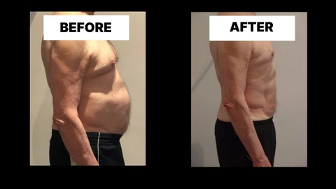 What Symptoms Can Diastasis Recti Cause in Men? Weak Core, Back Pain and Poor Posture Lincolnshire